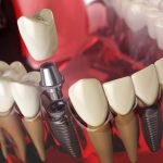 Имплантация зубов: инновационные технологии для красивой улыбки и здоровья